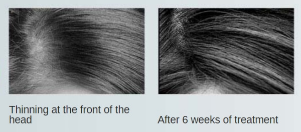 Follicle RX Testimonials, Reviews, and Comments