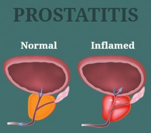 Prostatix Ultra Capsules Review | Get Rid of Prostatitis