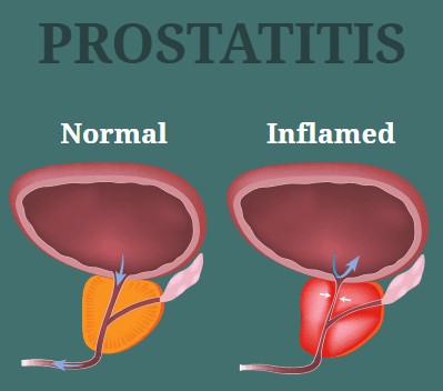 Prostatix Ultra 