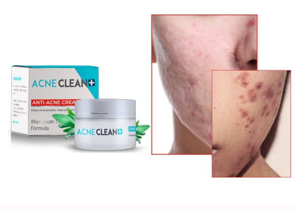 Pimples cream, acne, skin problems