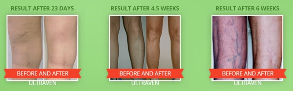 Anti-Varicose Veins Gel 