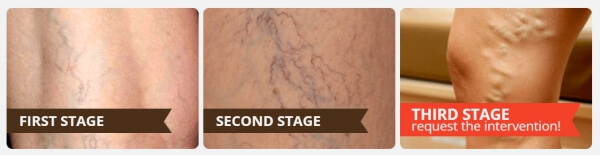 gel for varicose veins