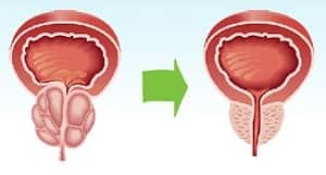 ingredients prostatitis