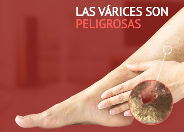 mitos sobre las venas varicosas