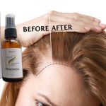 Minoxidil serum Review Mexico - Price, opinions and effects