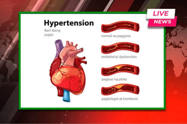 Hypertension & Blood Clots